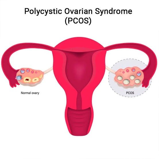 PCOS herbal support