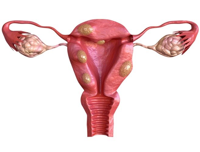 Fibroid support